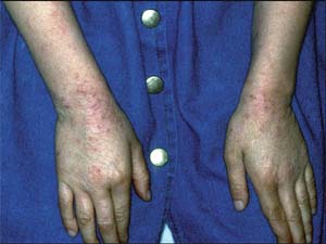 Wyprysk atopowy - atopowe zapalenie skóry: ręce i przedramiona