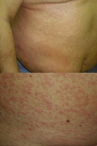 Generalized urticaria (top) and subsequent maculopapular
exanthema (bottom) caused by heparin